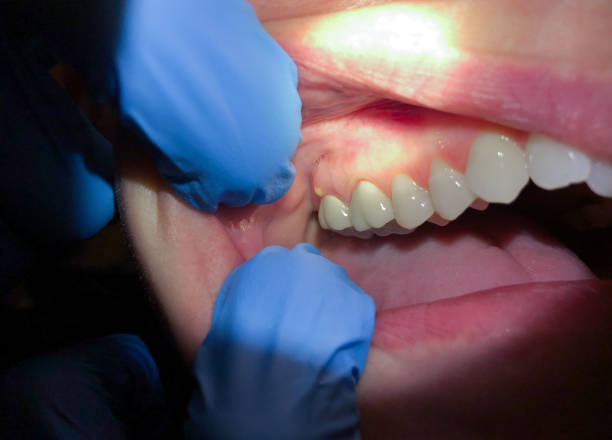 Best Emergency Dental Care for Broken or Chipped Teeth in Lake City, MN