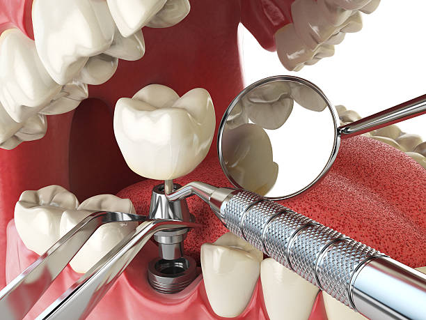 Best Emergency Treatment for Dental Infections or Abscesses in Lake City, MN